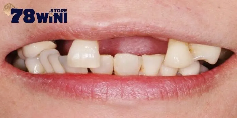 Mơ Thấy Rụng Răng - Điềm Báo Tương Lai Và Những Số Đề May Mắn 4 Gợi ý số đề khi nằm mơ thấy rụng răng